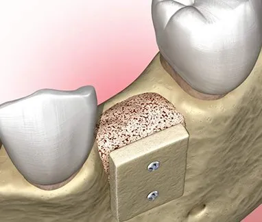 an illustrated example of a jaw bone after bone grafting has been completed