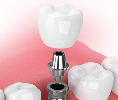 illustrated model of a dental implant and all of its parts