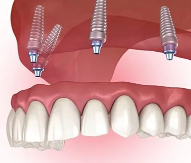 illustrated model of a implant supported denture