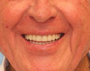 after image of dental implants