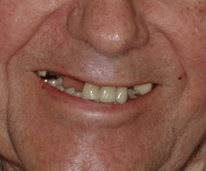 before image of dental implants