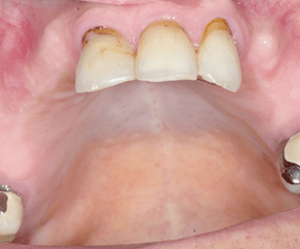 before image of dental implants