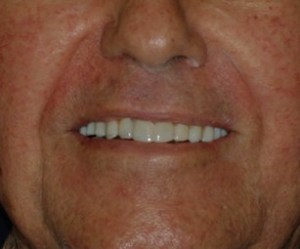 after image of dental implants