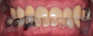 before image of a bad smile