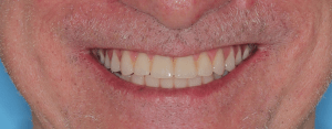 after image of corrective jaw surgery