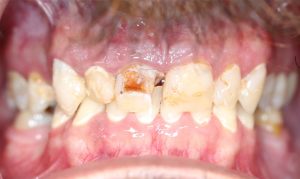 before dental implants