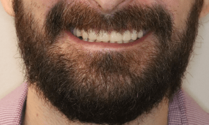 after dental implants