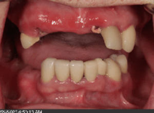 before dental implants