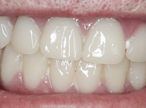 after image of a new smile