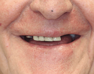 before image of dental implants