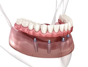 Removable,Prosthesis,All,On,4,System,Supported,By,Implants.,Medically