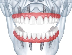 Prostheses,Supported,By,8,Implants.,Dental,3d,Illustration