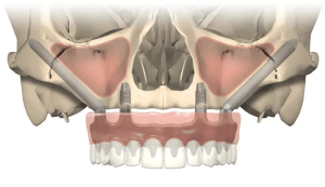 zygomatic implants